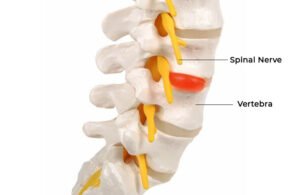 The Connection Between Lumbar Herniated Disc and Sciatic Pain: A Comprehensive Review Supported by Clinical Evidence