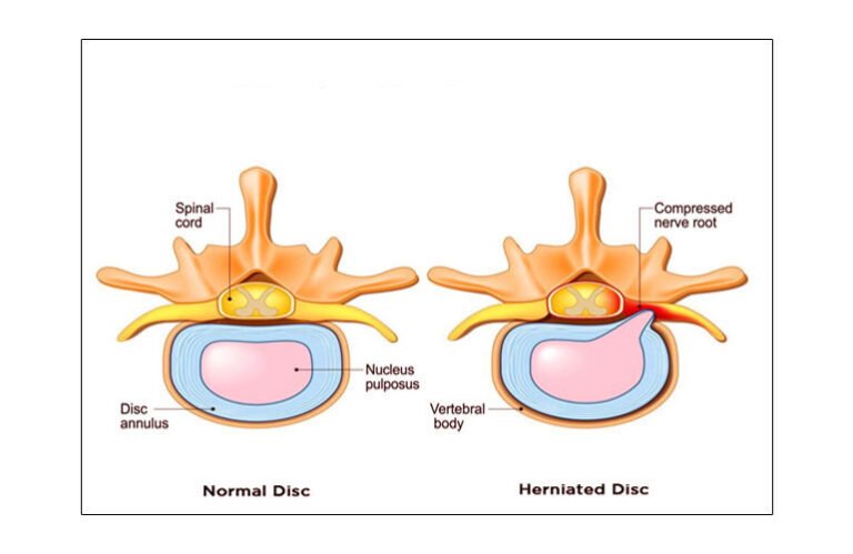 Disc Inbetween Spine Exploring the relation Between Smoking and Disc Herniation | ASPC ...