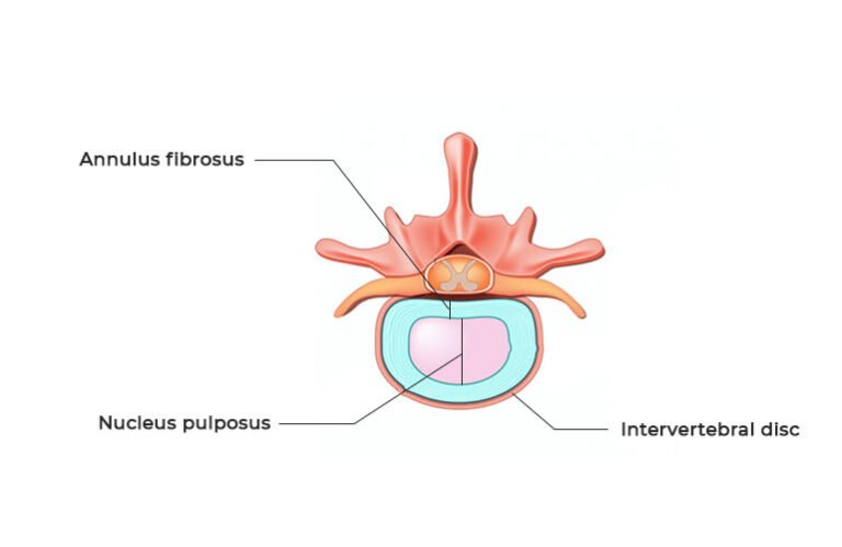 Lower back stretches to Relieve Lumbar Herniated Disc Pain | ASPC ...