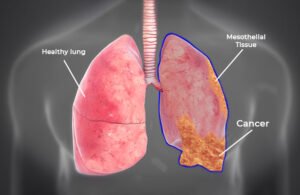 Why Do Some Lung Cancer Patients Experience Shoulder Pain