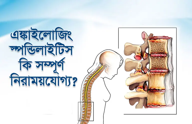 এঙ্কাইলোজিং স্পন্ডিলাইটিস কি সম্পূর্ণ নিরাময়যোগ্য
