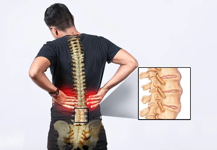 তরুণদের-মধ্যে-কোমর-ব্যথার-কারণ-এঙ্কাইলোজিং-স্পন্ডিলাইটিস