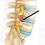 PLID treatment and physiotherapy rehabilitation at ASPC in Dhaka